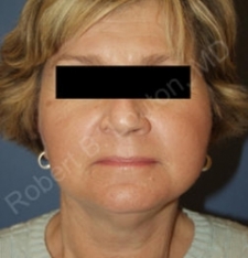 Facelift
